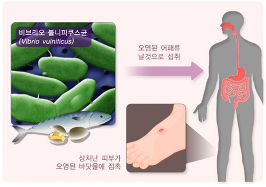서천군보건소, 비브리오 패혈증 및 레지오넬라증 주의 당부